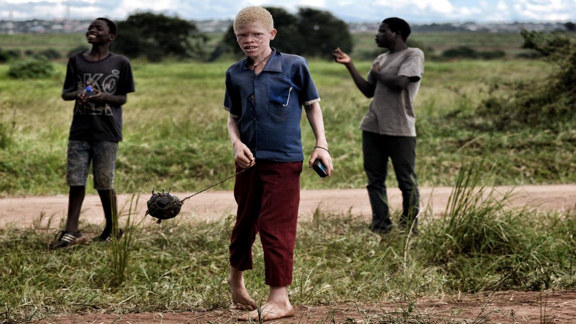 فتى أمهق في ملاوي- فرانس برس