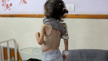 أطفال غزة يعانون من سوء التغذية، 1 يونيو 2024 (الأناضول)